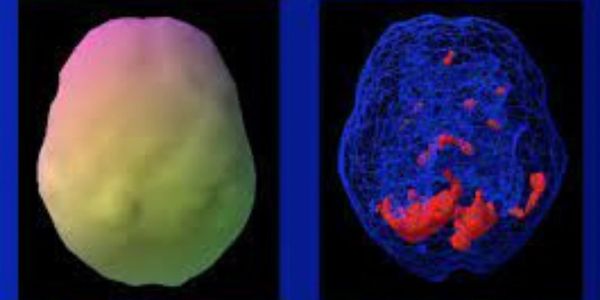 Amen Clinic referral for a SPECT scan.