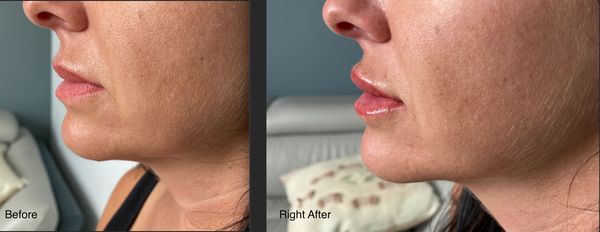 Natural looking lip filler (before and right after the procedure)