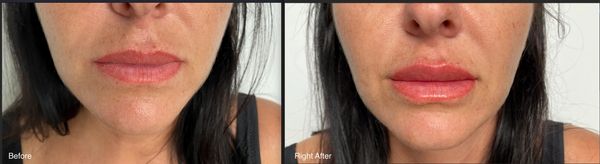 Natural-looking lip filler (before and right after the procedure)