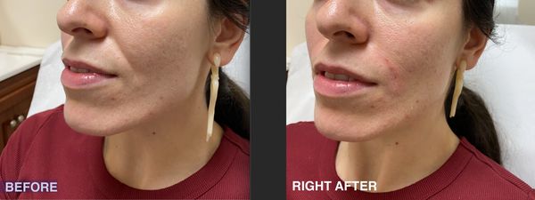 A smoother and more youthful appearance after filler treatment for nasolabial folds.