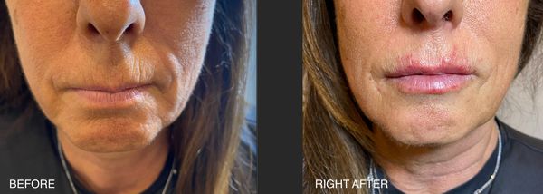 Gentle rejuvenation of the perioral area without looking overdone. 