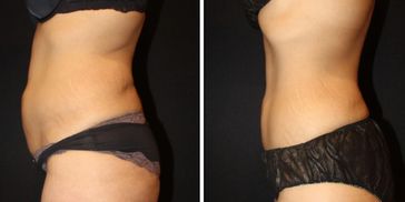 liposuction