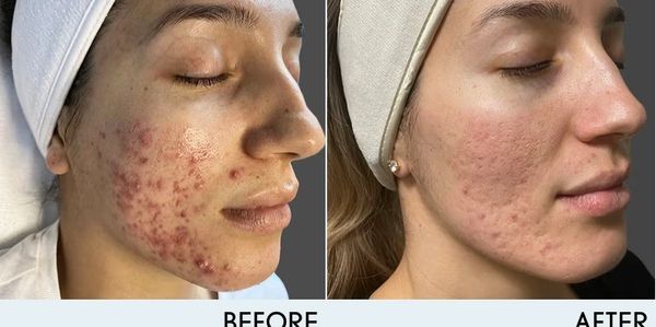 Face Reality acne products