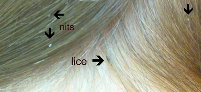 lice in blonde hairTikTok Search