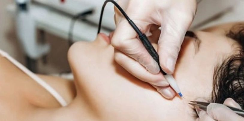 Electrolysis: The Only FDA-Approved Method for Permanent Hair Removal