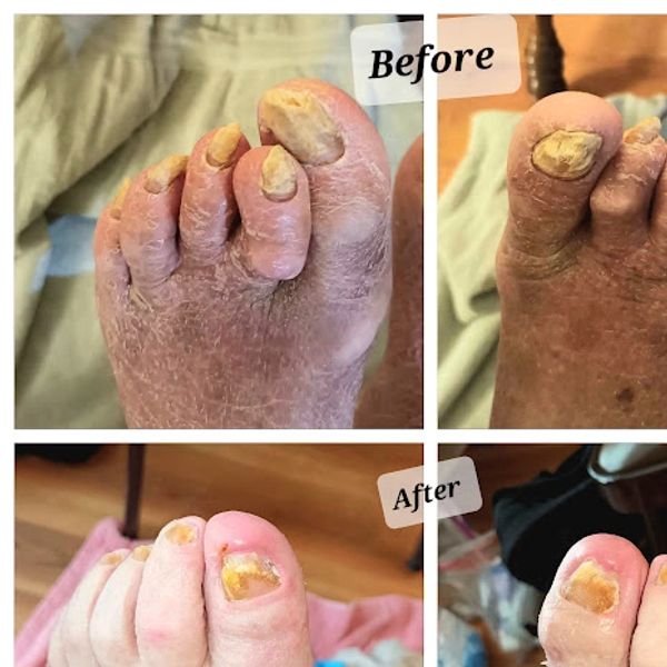 Before and after images of toenail treatment showing significant improvement.