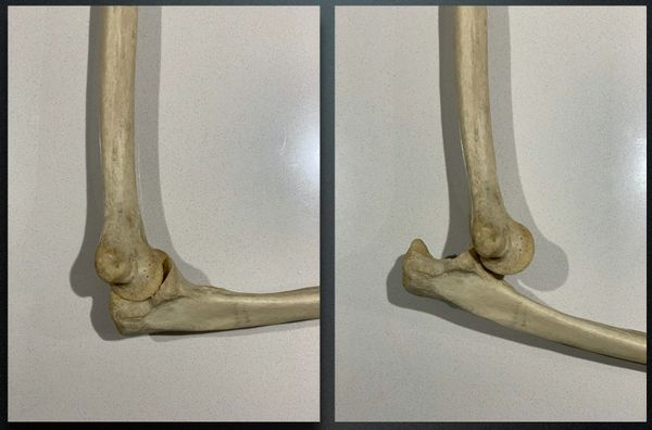 posterior elbow dislocation