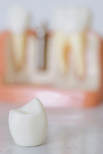 Implante Dentare