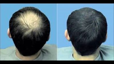 Scalp RF Microneedling for hair loss treatment