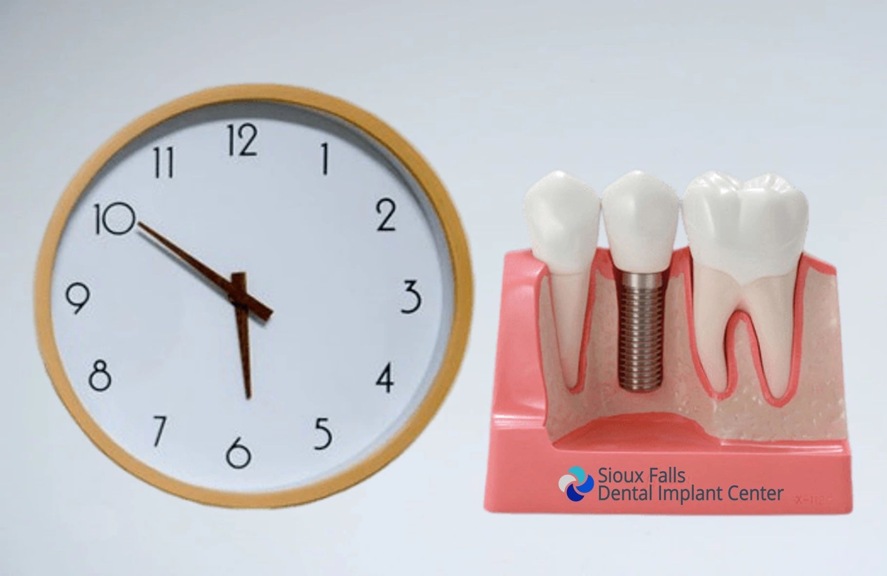 How Long Does the Dental Implant Process Take?