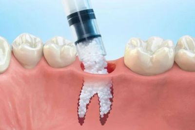 bone-grafting-sioux-falls-sd