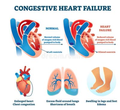 Infographic showing congestive heart failure effects on heart, lungs, legs, and feet.