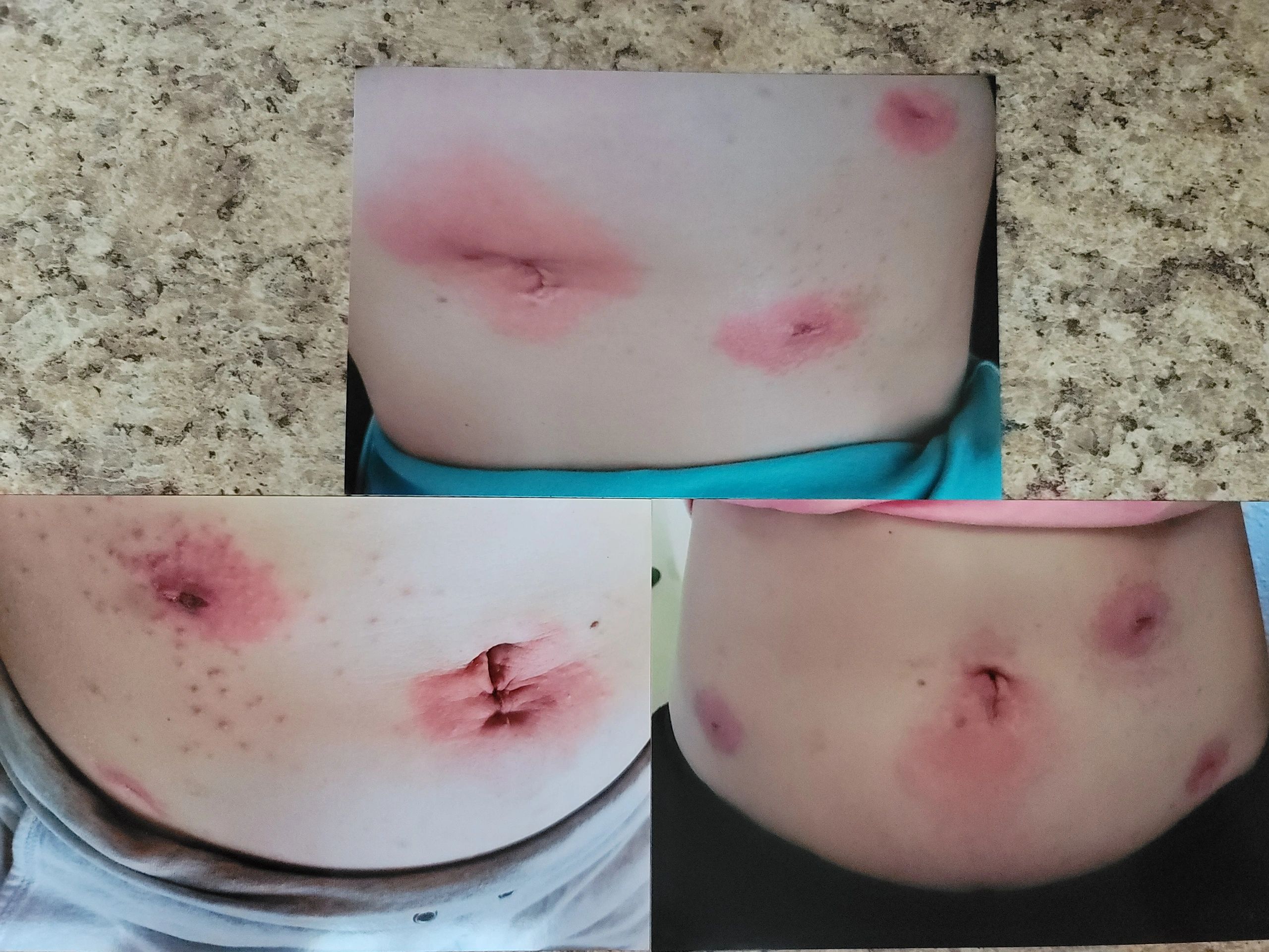 5 days PO - allergic reaction to dermabond : r/tummytucksurgery