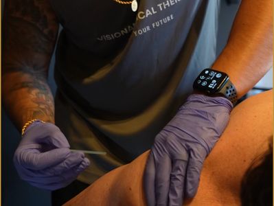 Dry needling treatment at Visionary Physical 
Therapy clinic in Fairfield CT