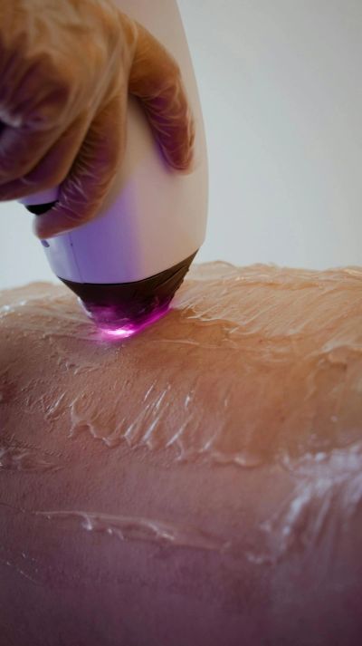 Laser hair removal treatment on skin.
