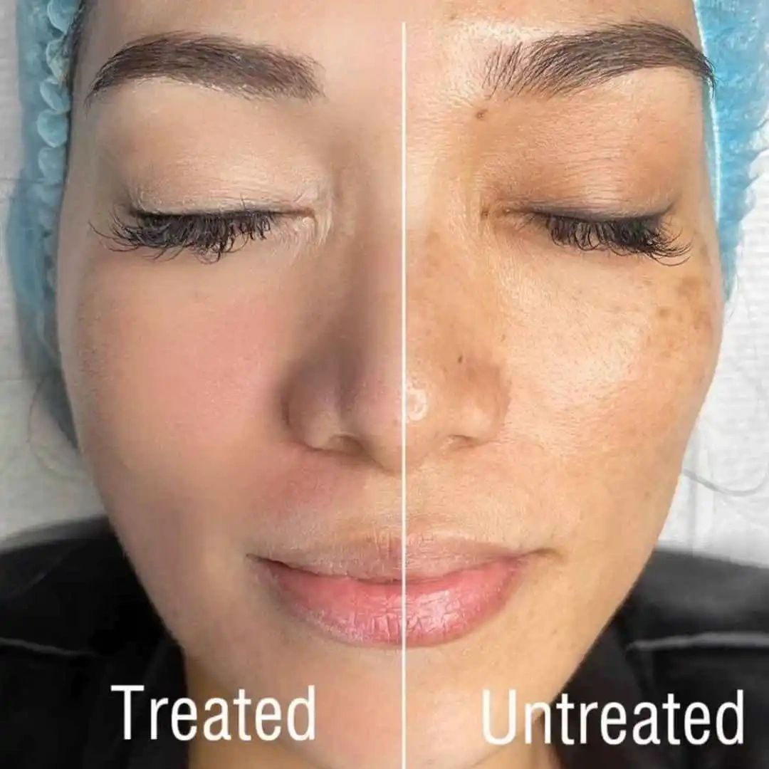 Before and After Glow Before and After Glow