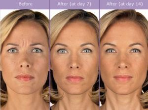 Contact us today to schedule your BOTOX consultation.