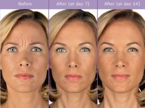 Contact us today to schedule your BOTOX consultation. Contact us today to schedule your BOTOX consultation.
