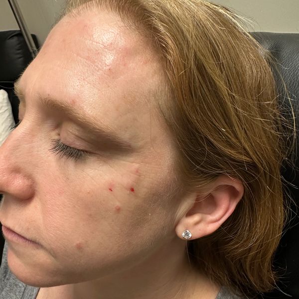 Botox crows feet treatment