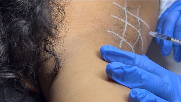 Botox treatment for hyperhidrosis: precise injections in the underarm to reduce excessive sweating.


1/2









Ask ChatGPT
