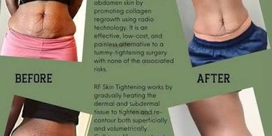 Before and after photos showing skin tightening results on the abdomen and thigh.