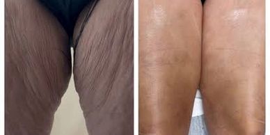 This process simultaneously tightens skin and strengthens muscle fibers in the legs and thigh area w