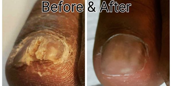 "Toenail Restoration" is prefect for damaged dry brittle nails. 