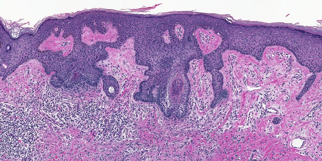 Histology slide showing skin tissue with cellular structures.