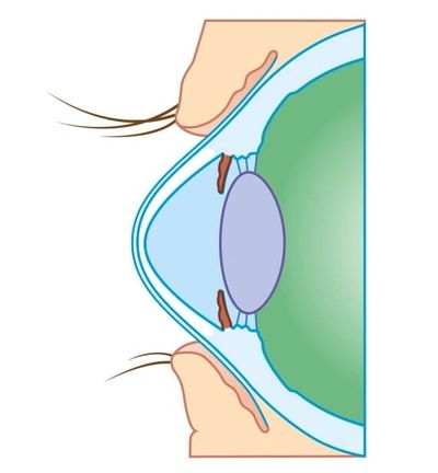 Cross-sectional illustration of an eye showing eyelashes and cornea.