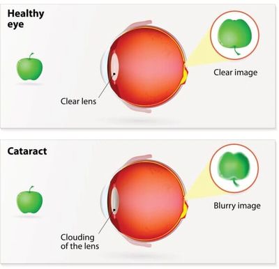 Comparison of healthy eye and cataract-affected eye with clear vs blurry image.