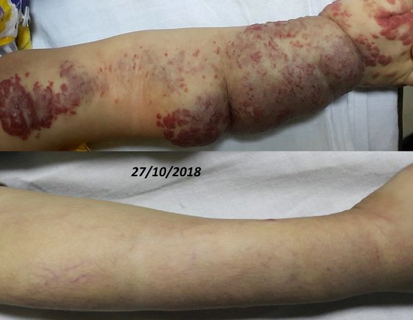 علاج الوحمة الطفولية هيمانجيوما