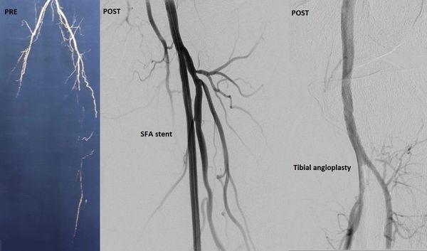 توسيع ودعامات شرايين طرفية