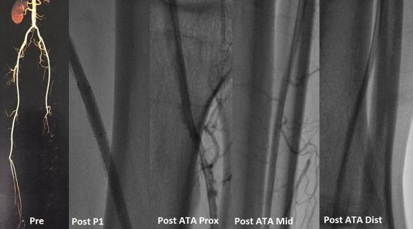 إذابة جلطات الشرايين