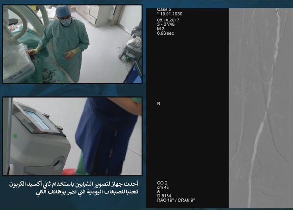 قسطرة بدون صبغة