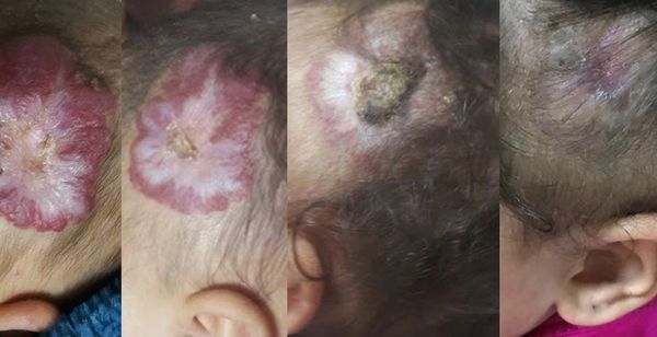 علاج الوحمة الطفولية هيمانجيوما