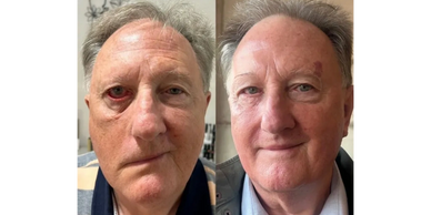 Bells Palsy Treatment