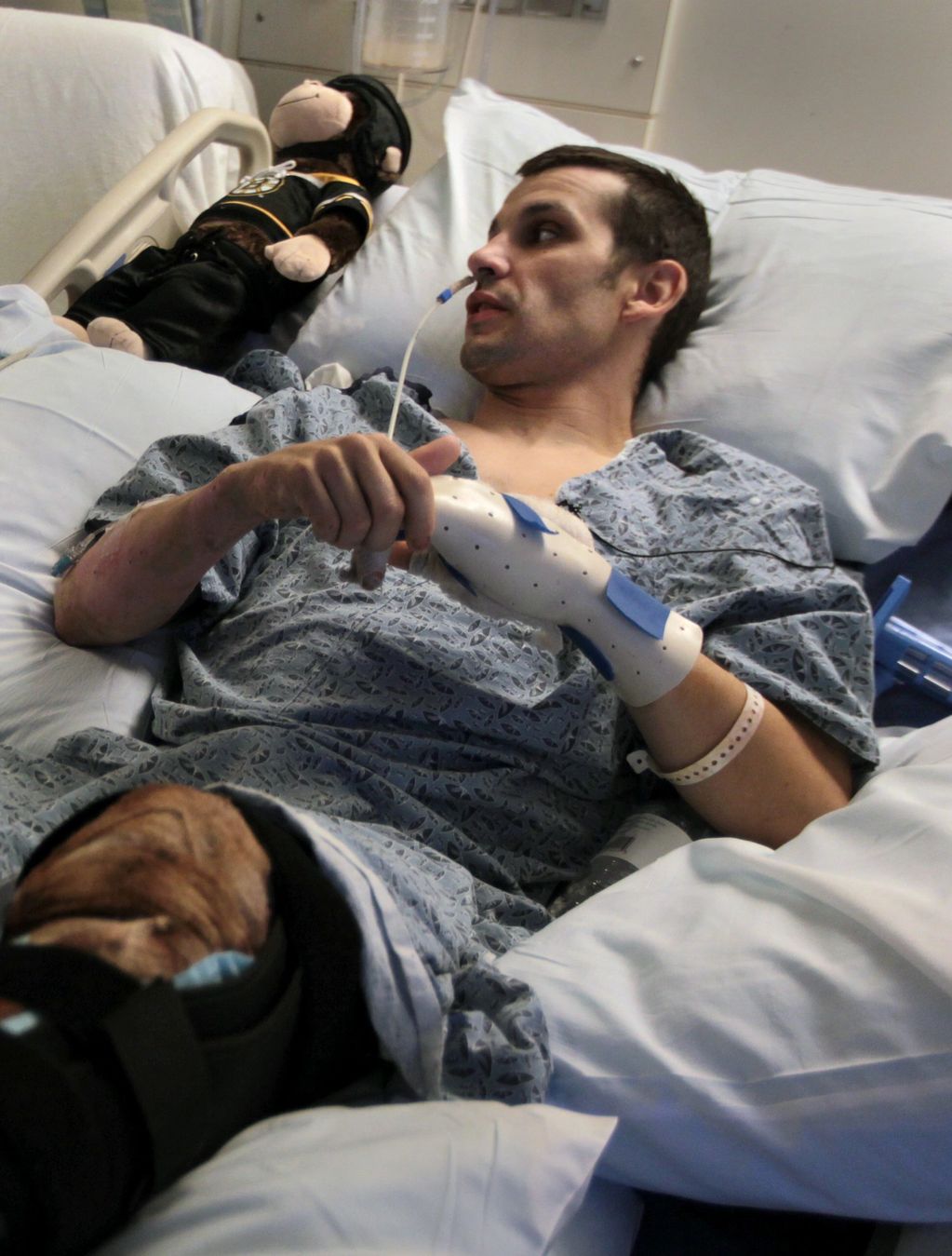 burn floor, burns, feeding tube , Boston Marathon bombing 