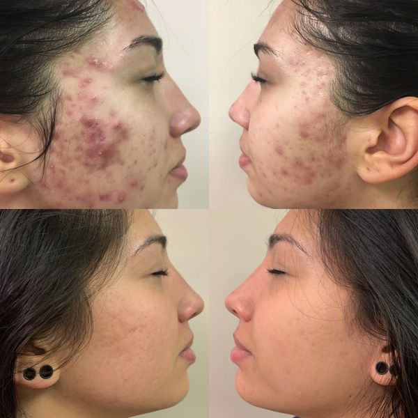 Before and after photos from a 12-week acne scar and pigmentation protocol.  
