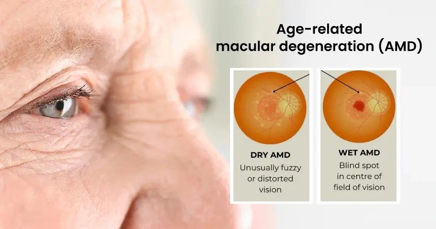 Age-related macular degeneration