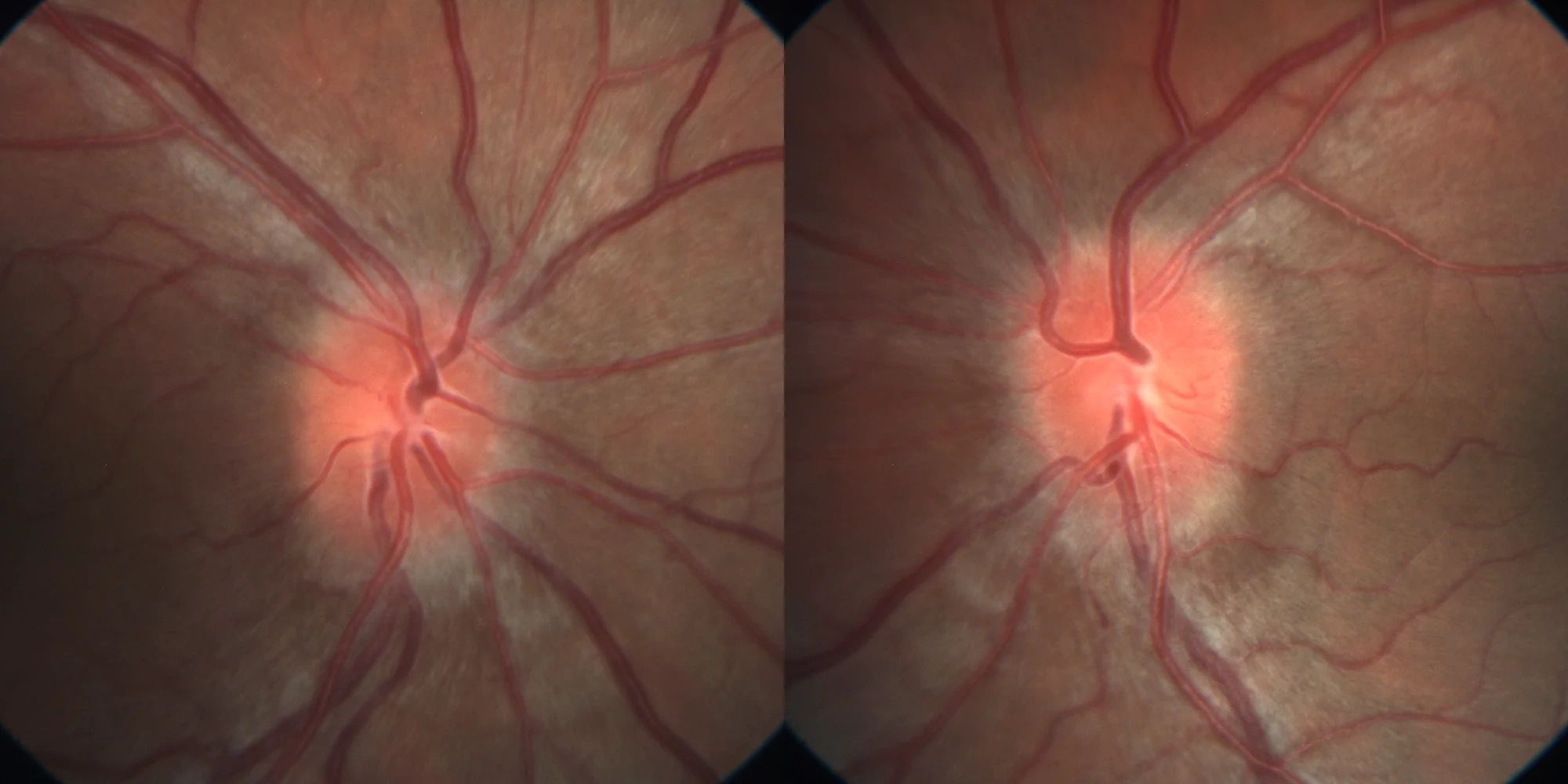 Papilledema
