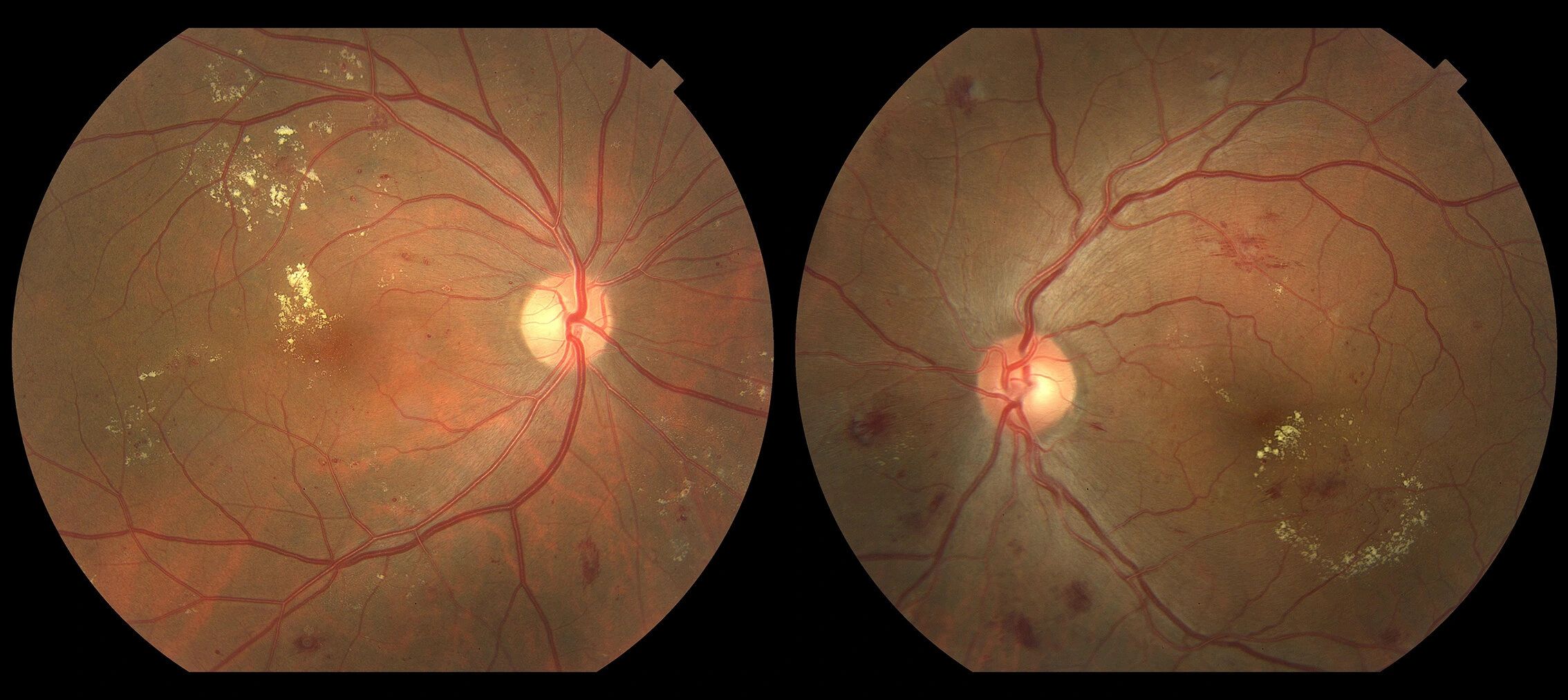 Diabetic retinopathy