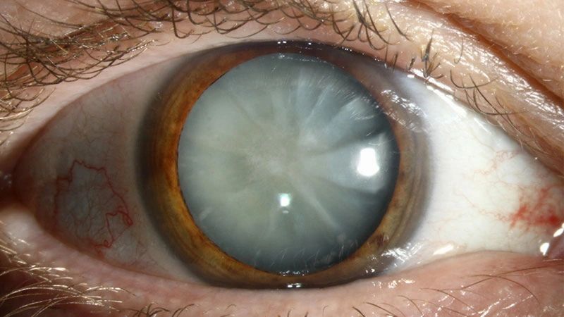 Cataract