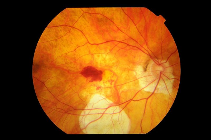 Myopic macular degeneration