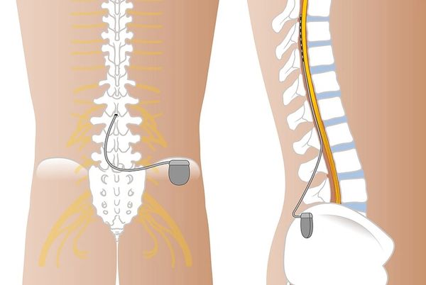 🥇 Atlanta Spinal Cord Stimulation SCS