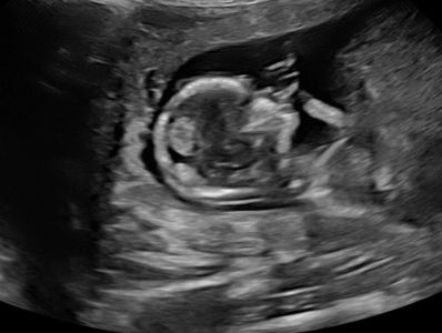 Baby Ultrasound 