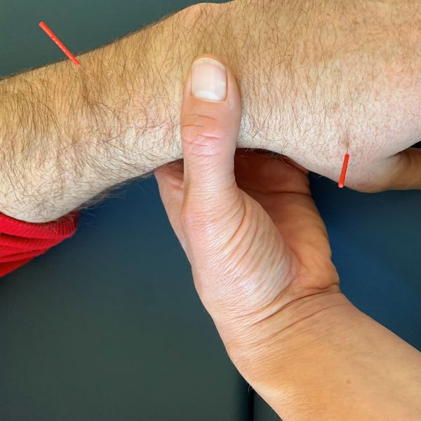 Needles placed in a hand and arm