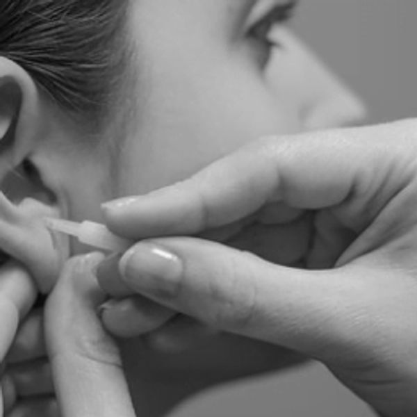 Lady having ASP needle placed in her ear for pain relief using the Battlefield acupuncture protocol