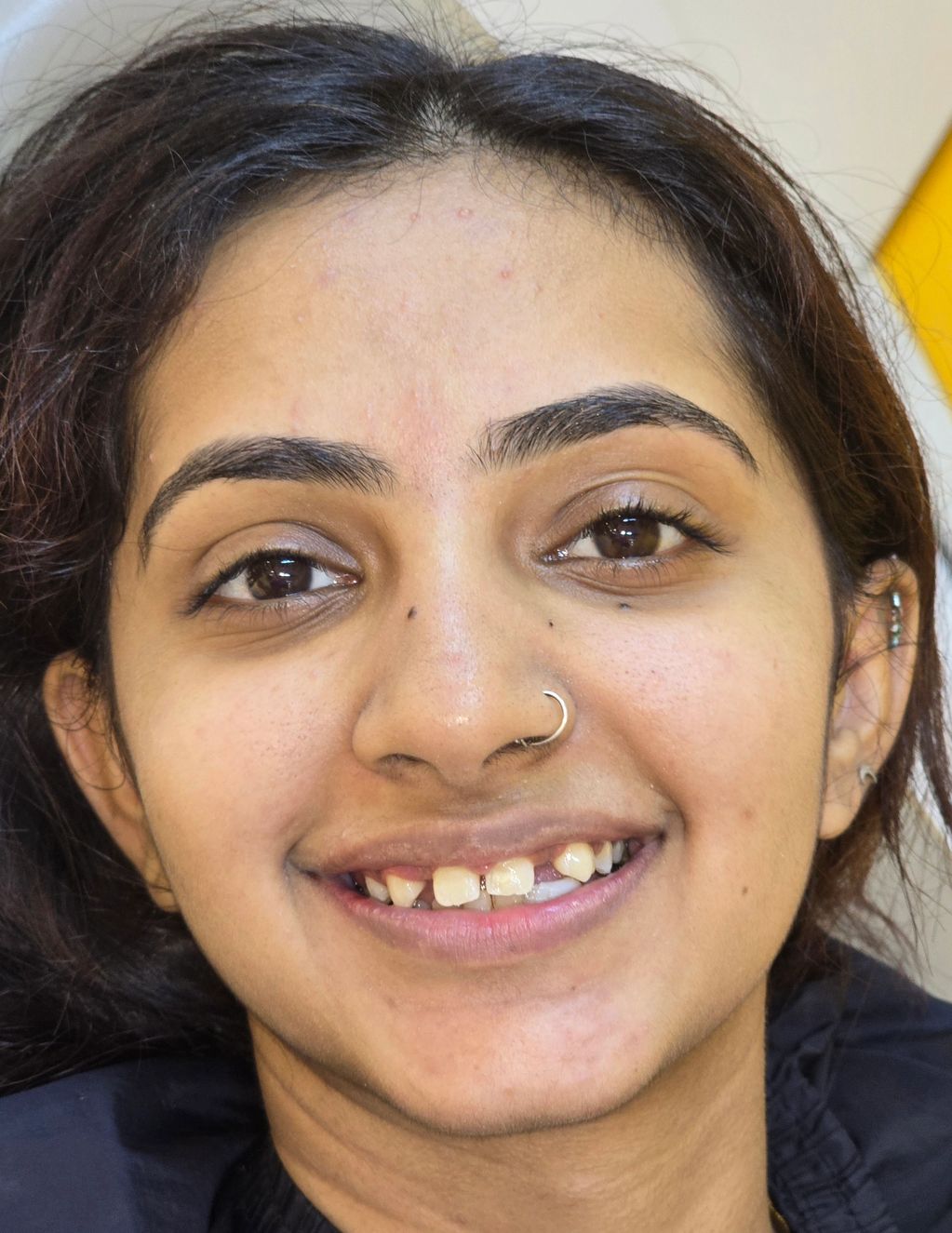 PATIENT COMPLAINED OF SHYNESS AND INABILITY TO FACE PEOPLE SOCIALLY DUE TO UNESTHETIC SMILE. 