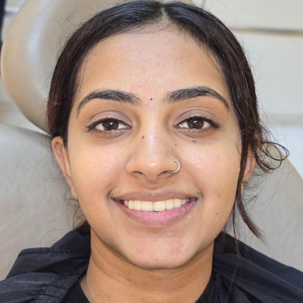 A BOLD AND CONFIDENT FEMALE AFTER TREATMENT FOR RESTORATION OF SMILE AND FUNCTION ACHIEVED IN 1 WEEK