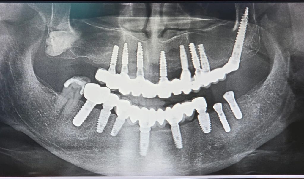 Recent X ray of a patient replacing his decayed, mobile teeth with dental implants with us.